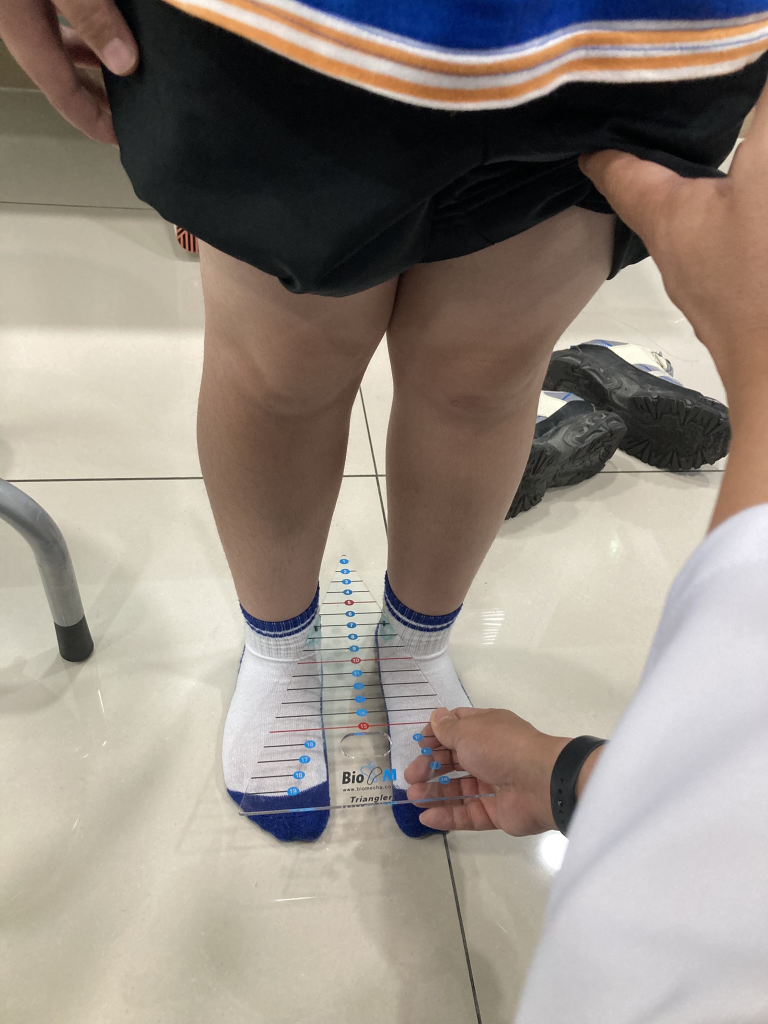 X자다리 무릎·발목 간격 측정 모습