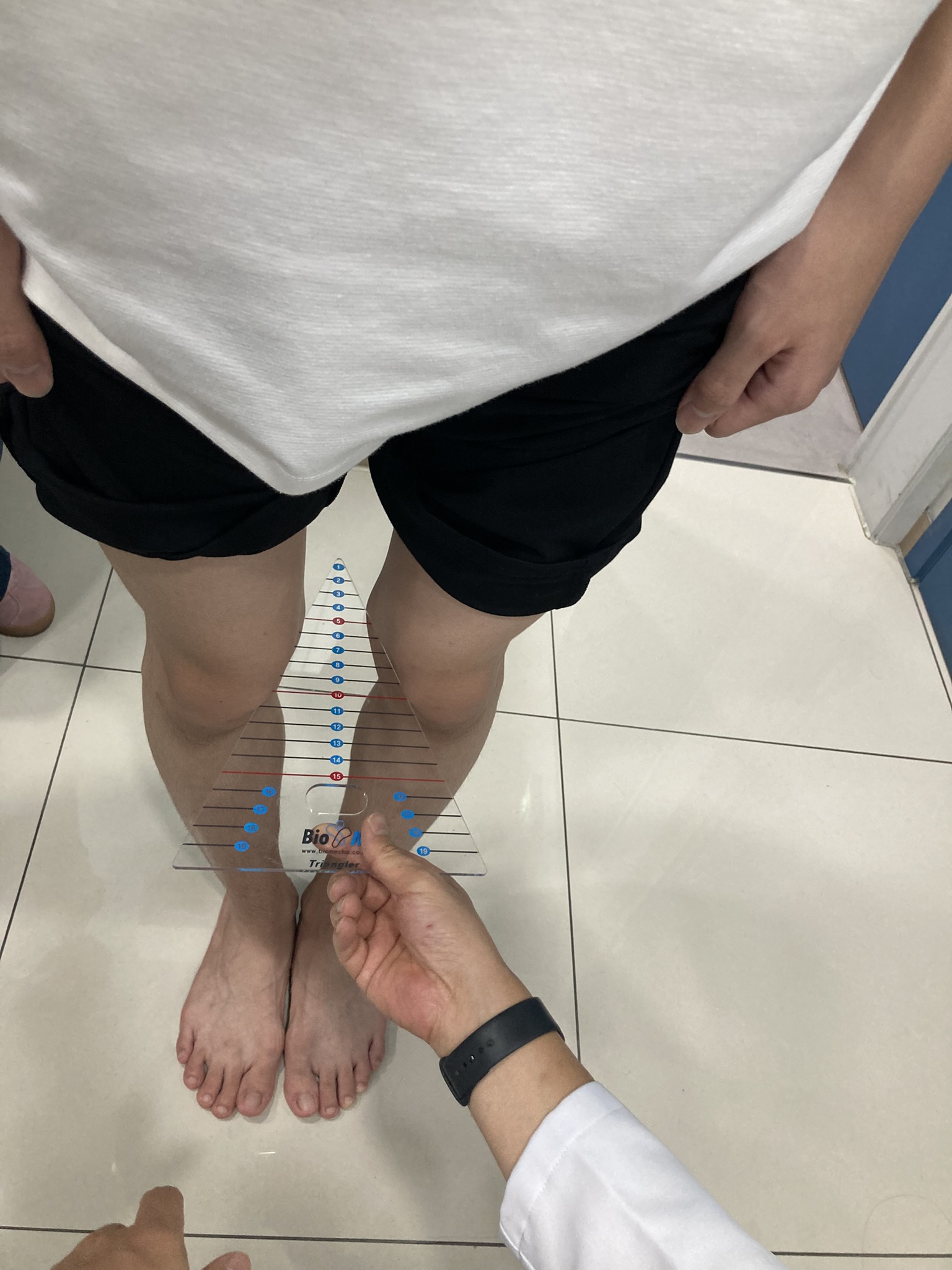 O자다리 무릎 간격 측정 모습