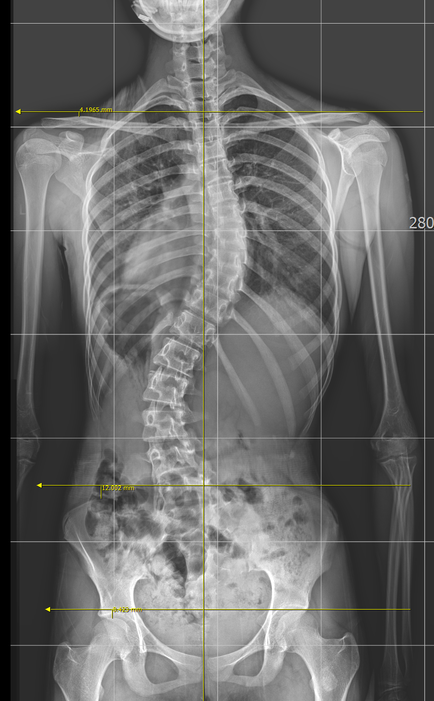 척추측만증 X-ray 측정 이미지